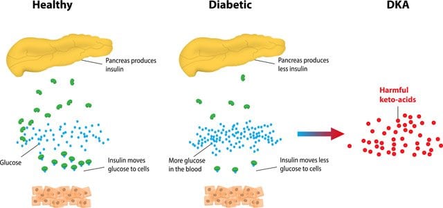 Understanding Ketones - Diabetic Live